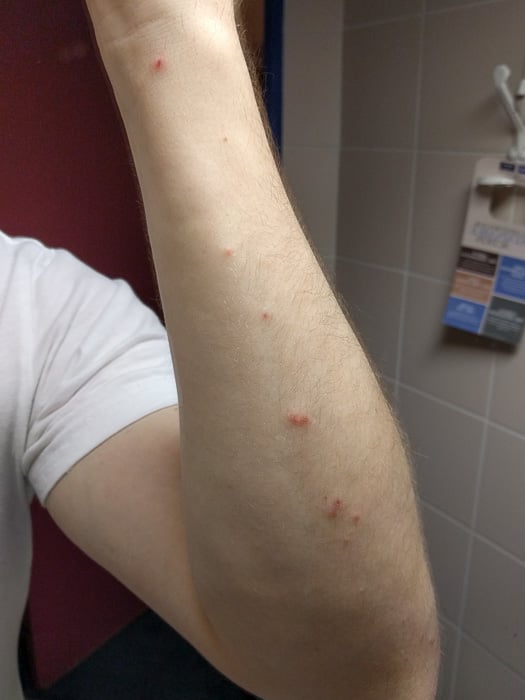 Bites on an arm from Bed Bugs